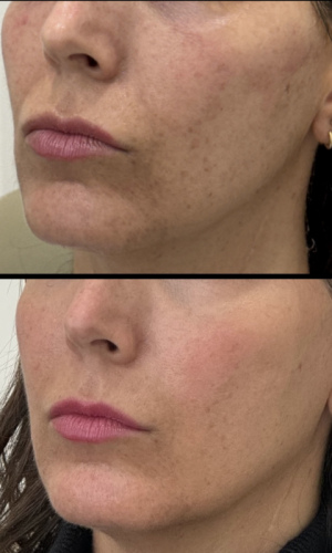 rf-microneedling-before-and-after