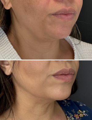 Before-After-Liposuction-NYC-4