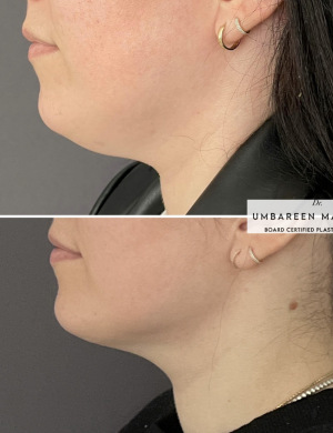 Submental-liposuction-before-and-after-032723-1
