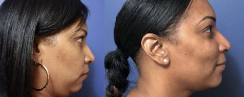 liposuction-chin-before-after