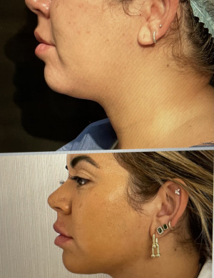 submental-liposuction-before-after-1