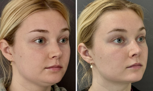 submental-liposuction-before-after-5