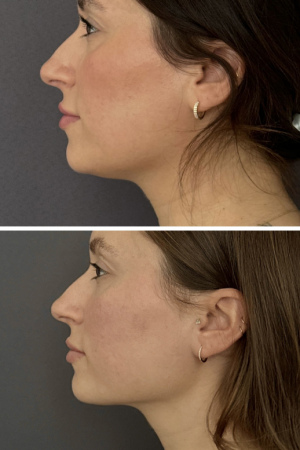 submental-liposuction-nyc-before-after-photo-10