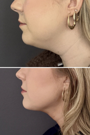 submental-liposuction-nyc-before-after-photo-11