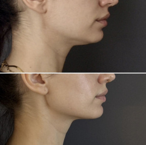submental-liposuction-nyc-before-after-photo-14