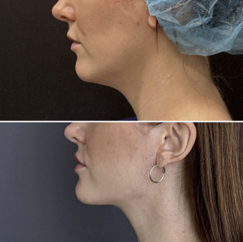 submental-liposuction-nyc-before-after-photo-17