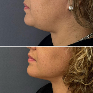 submental-liposuction-nyc-before-after-photo-7