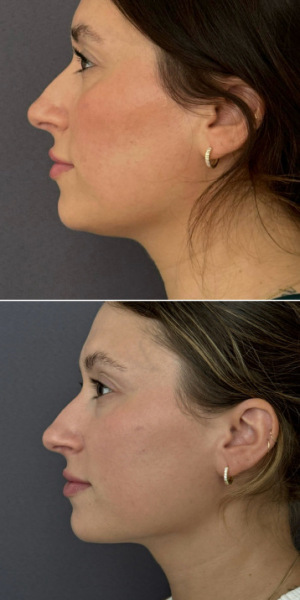 submental-liposuction-nyc-before-after-photo-8-1