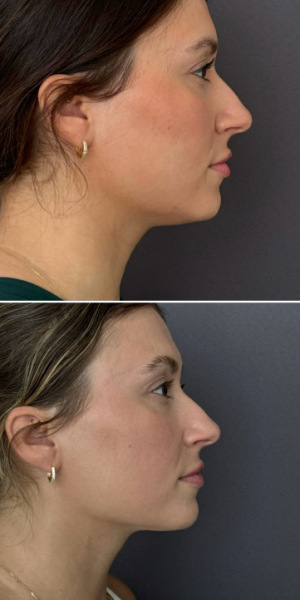 submental-liposuction-nyc-before-after-photo-8-2