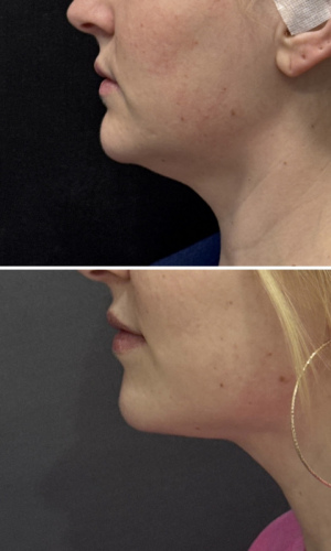 submental-liposuction-nyc-before-after-photo-9