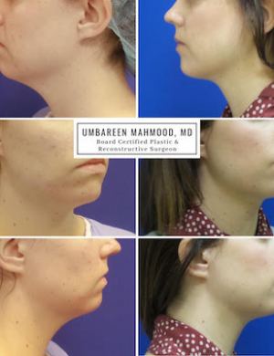 submental-liposuction-profile-before-after-2