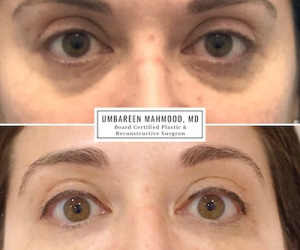 Before-After-Eye-Fillers