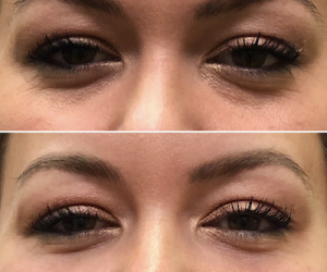 Before-After-Eye-fillers-2