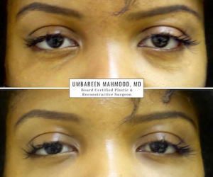 Before-after-Eye-fillers