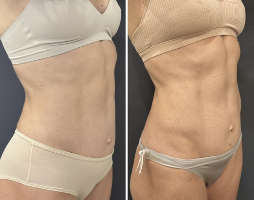 truflex-muscle-toning-nyc-7